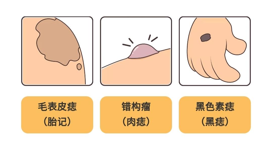 健康生活痣也可能會癌變長在3個地方要注意