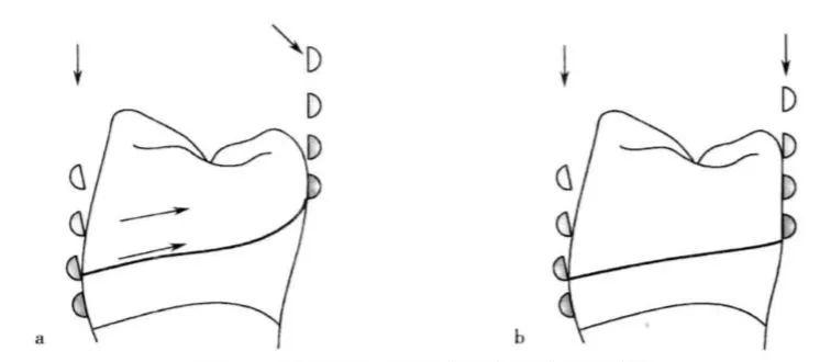 可摘局部义齿的牙体预备