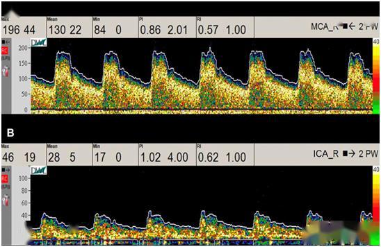 你所不知道的经颅多普勒(5):异常血流频谱之流速增快