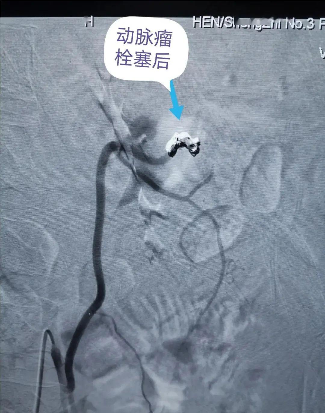 小肠血管畸形图片