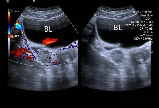 膀胱三角区乳头状突起你能考虑到这个疾病吗