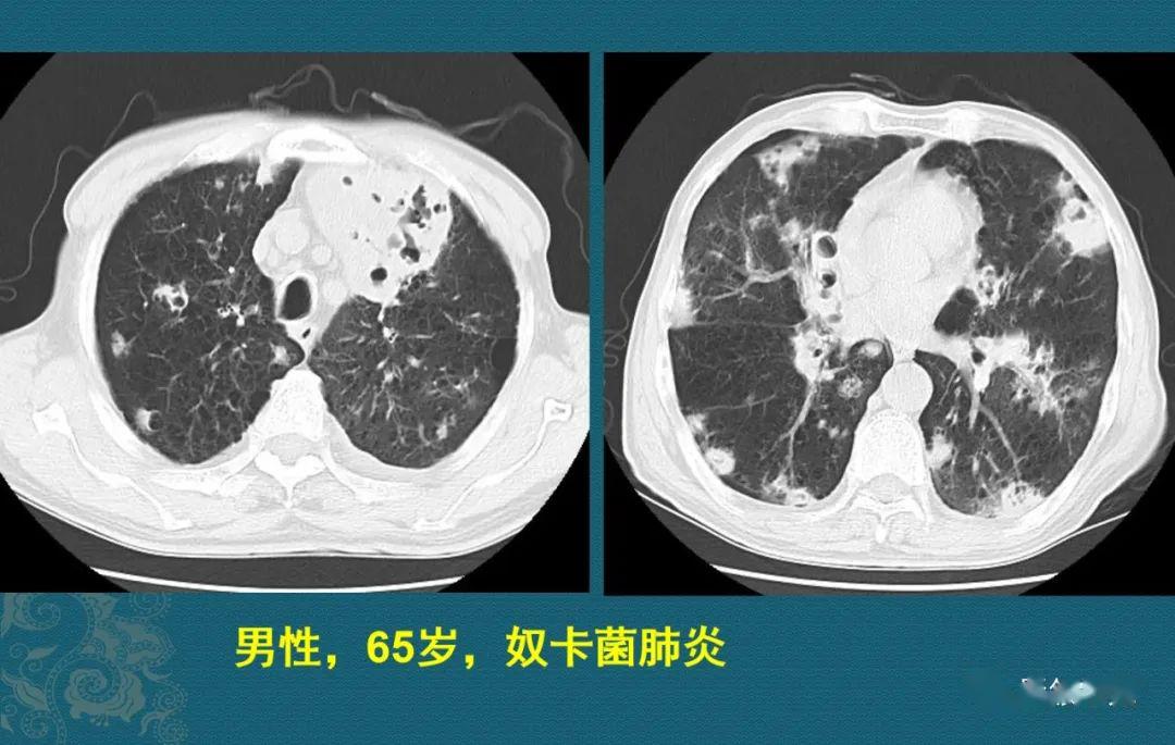 豪哥说肺炎:奴卡菌肺炎趣解