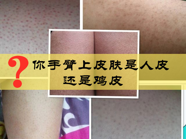 导致鸡皮肤的原因有哪些(鸡皮肤是什么原因造成的?治的好吗)