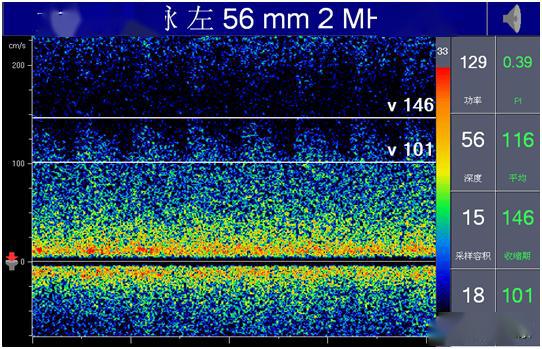 颅内多普勒血流图(tcd)图片