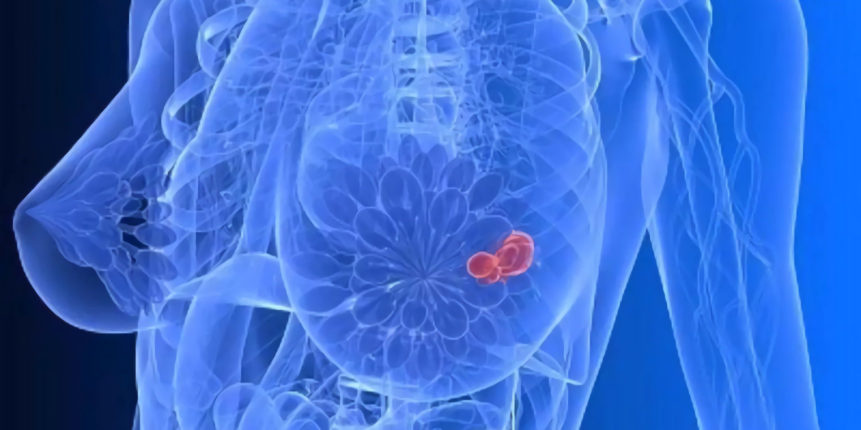 温和的乳腺纤维腺瘤,也要准确鉴别良性或恶性