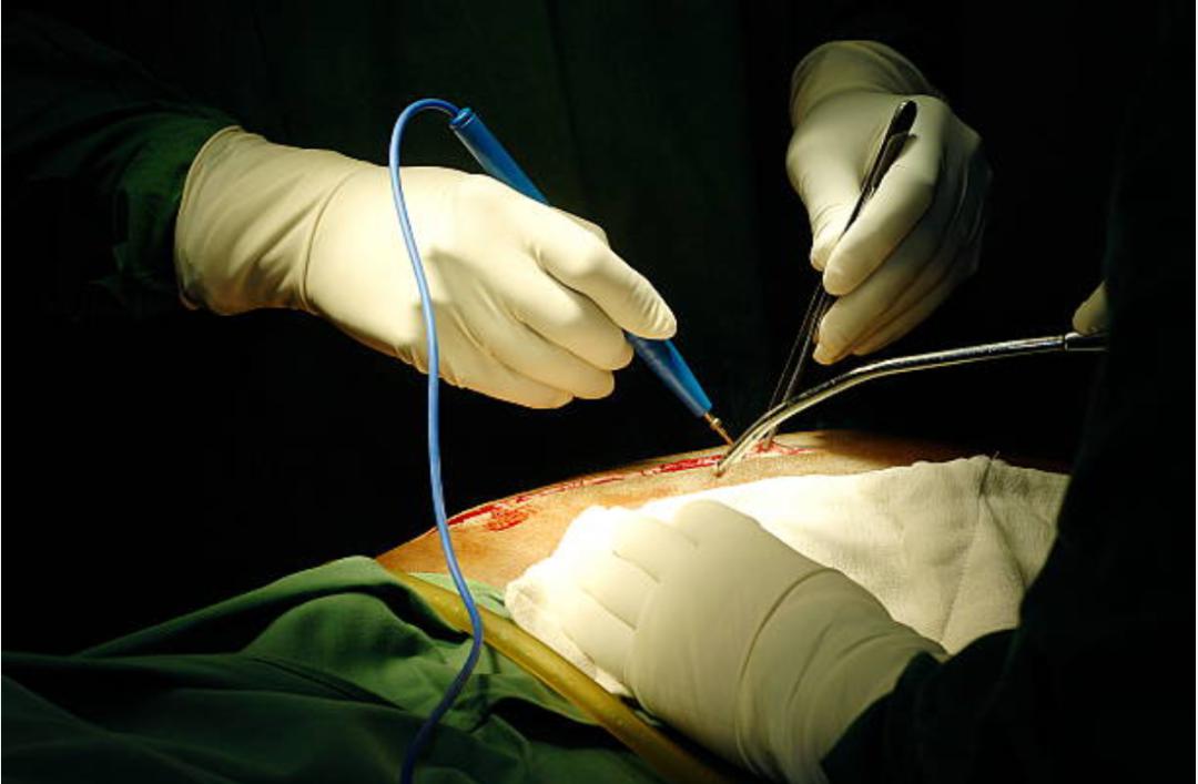 硬核减肥文!看完外科医生的日常"烧烤"秒减_手术