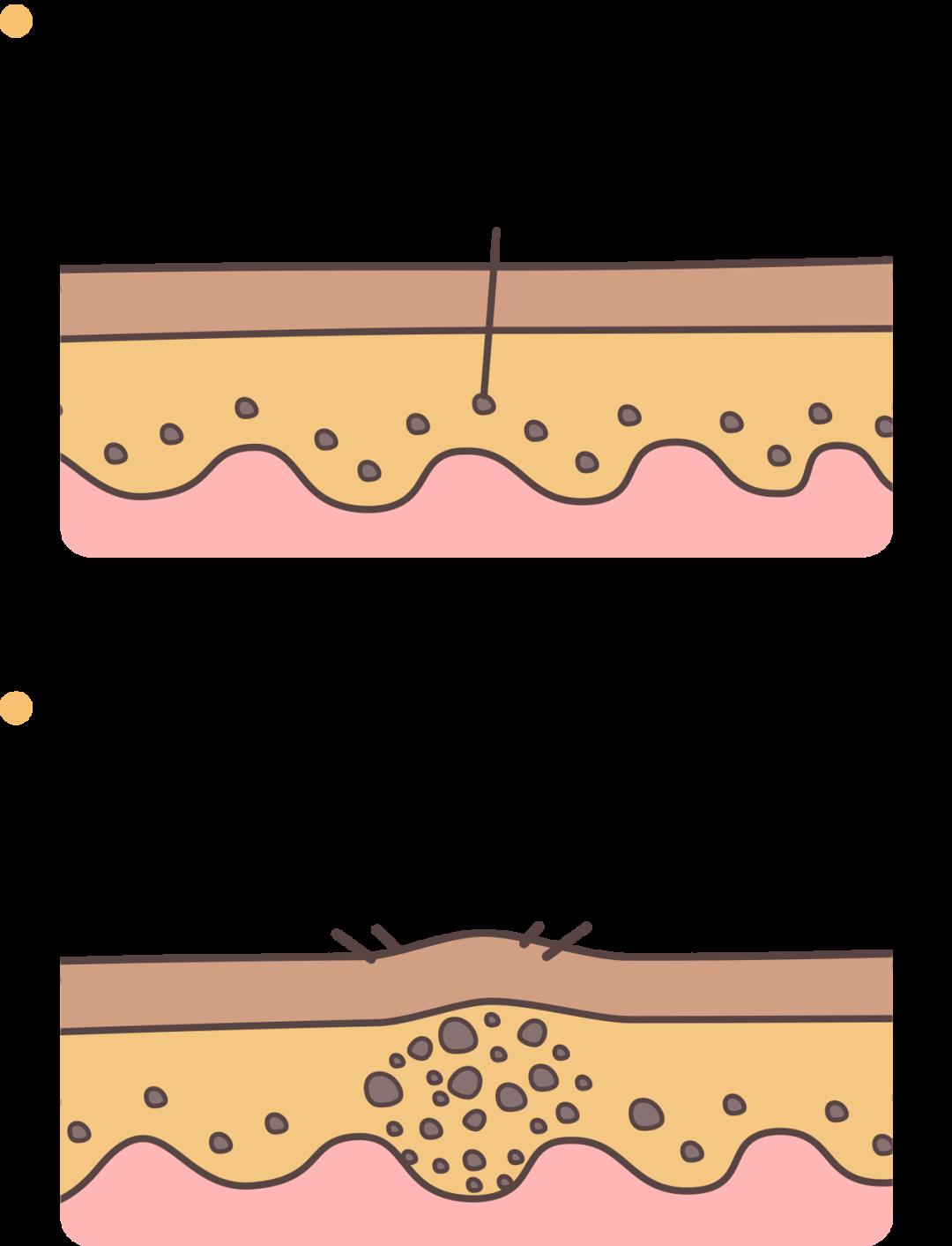 健康生活痣也可能会癌变长在3个地方要注意