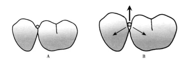 图8 预备隙卡沟,a为正确的方式;b为错误的方式总结:导平面预备,便于