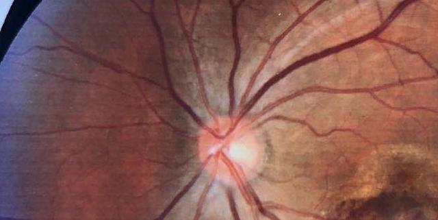 19岁小伙眼睛惊现火焰这是怎么回事和不良生活习惯有关