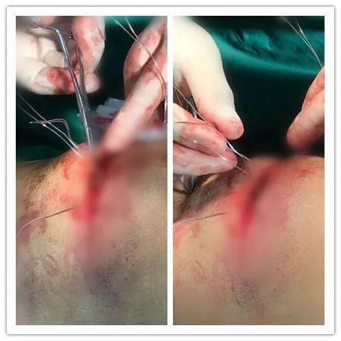 2—手术患者为老年女性,腰痛伴