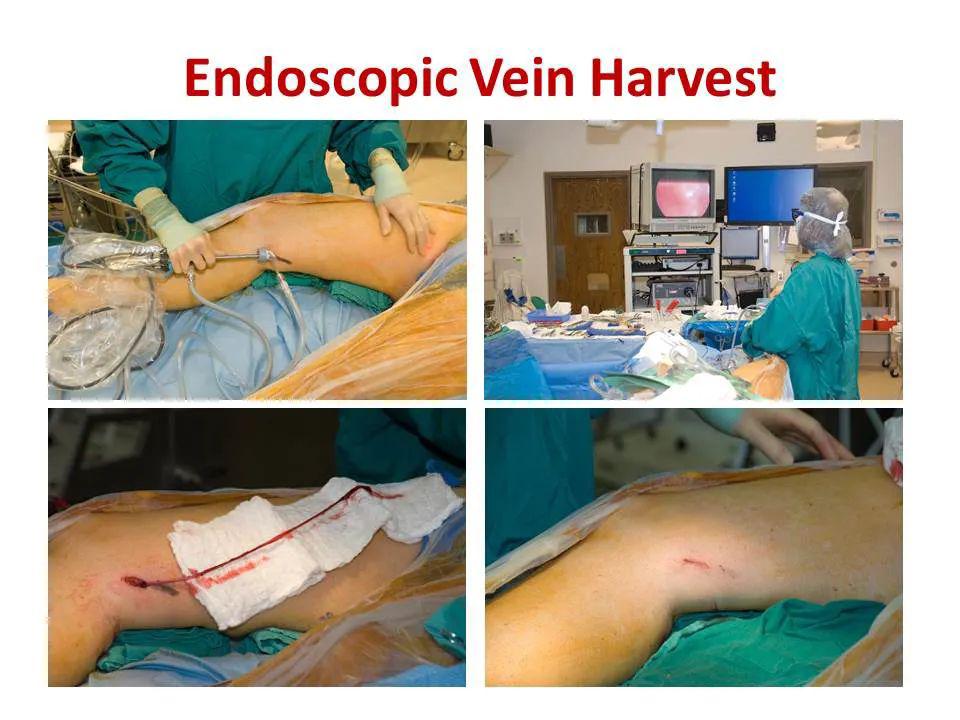 【交流】外科搭桥