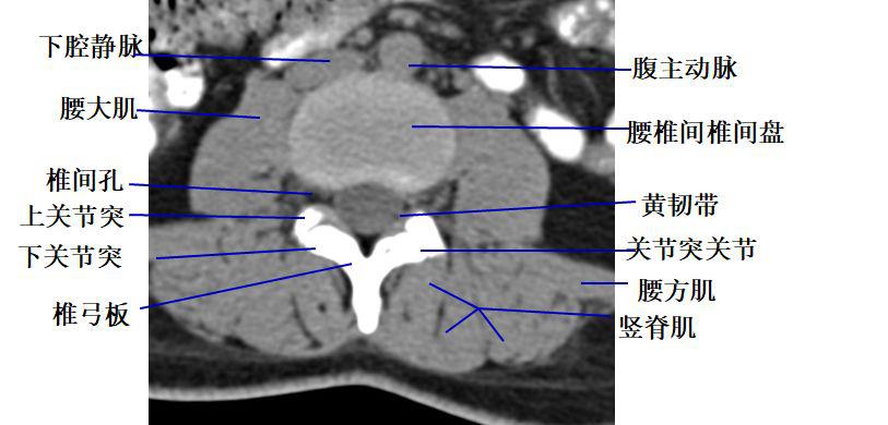 腰椎椎体ct断层解剖图图片