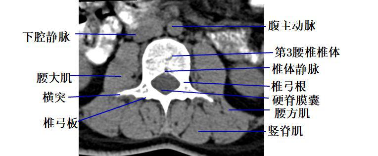 收藏貼頸椎腰椎ct常見病變你都瞭解嗎