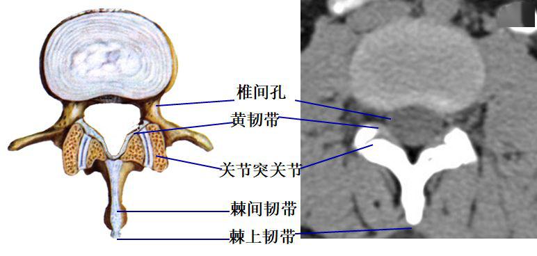 硬膜囊黄韧带图片