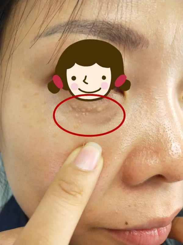 (汗管瘤)泛发性光泽苔藓,是一种较少见的无自觉症状的慢性炎症性丘疹