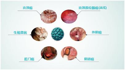 外阴癌前期图片