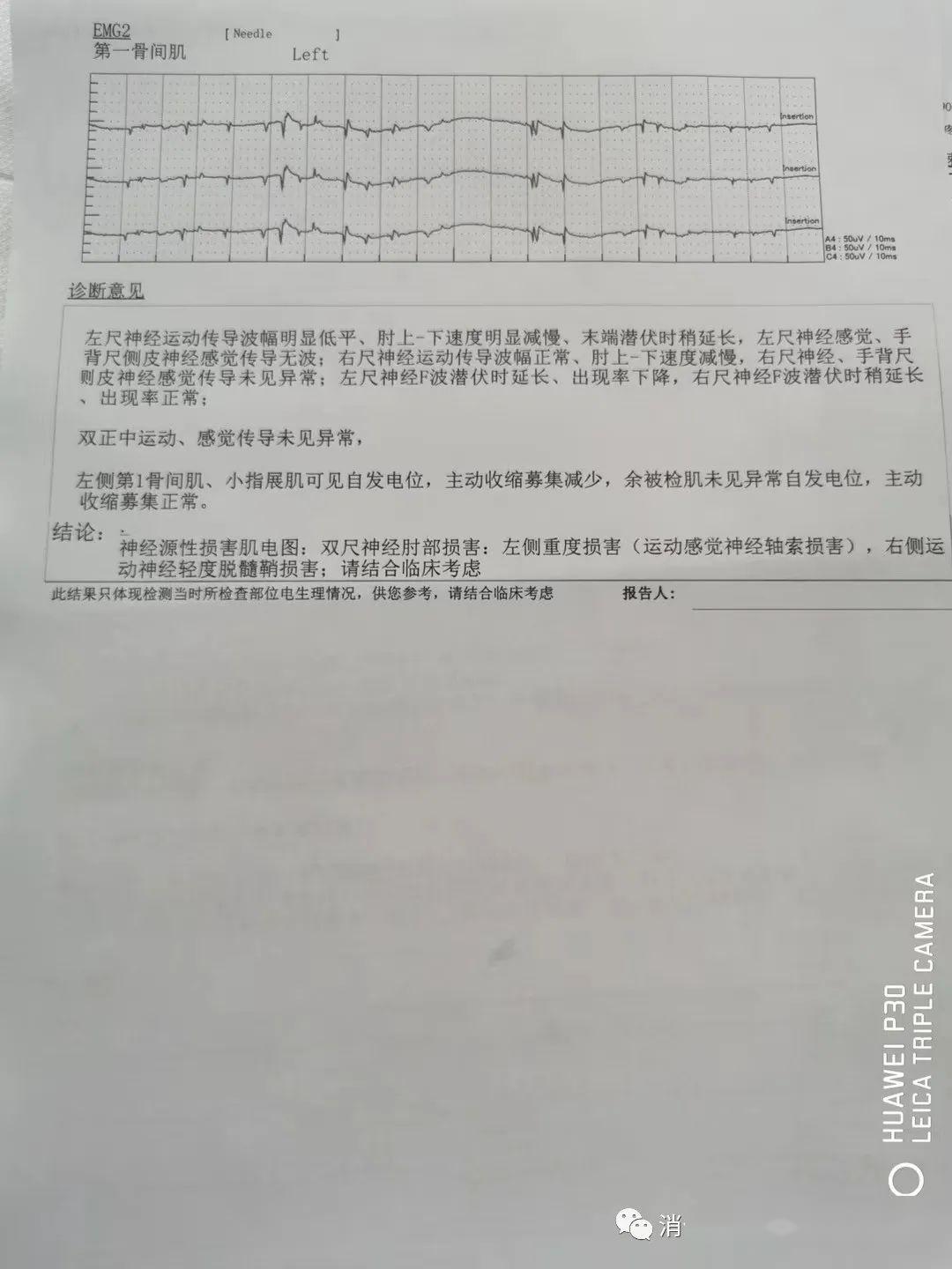 上肢肌电图检查结论:神经损害肌电图,结合病史双尺神经肘部损害,左侧