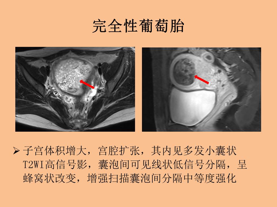 侵袭性葡萄胎图片