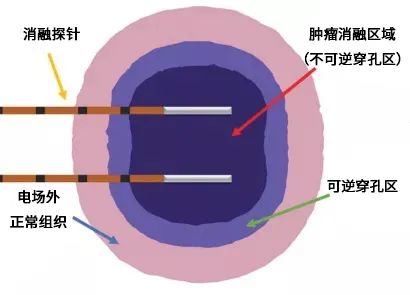 破解癌症的阿喀琉斯之踵-----不可逆电穿孔技术_细胞