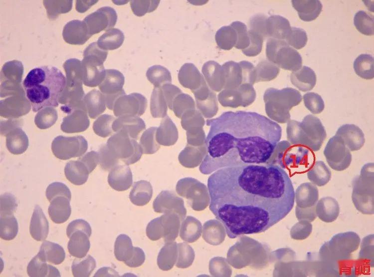 ▼「双核骨髓瘤细胞/双核异常浆细胞」形态特征:胞体呈不规则形;胞核