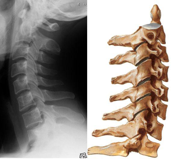 頸部的椎體一,頸 椎ct上均表現為軟組織密度結構,ct值約40hu～50hu.