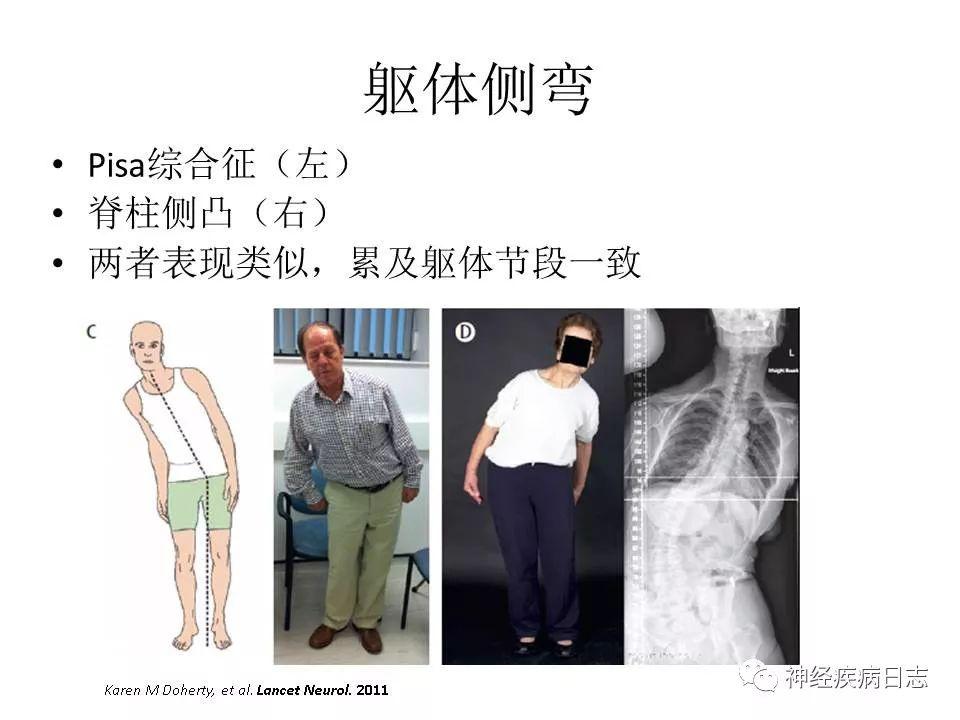 帕金森病中的肌张力障碍