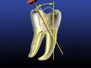 操作技巧镍钛根管器折断的预防小知识牙医速度收藏吧