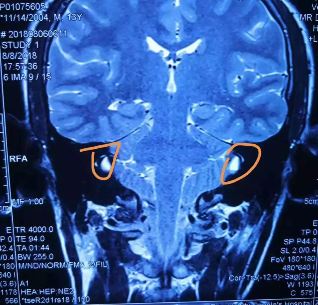 大前庭导水管综合症的听力学诊断与干预