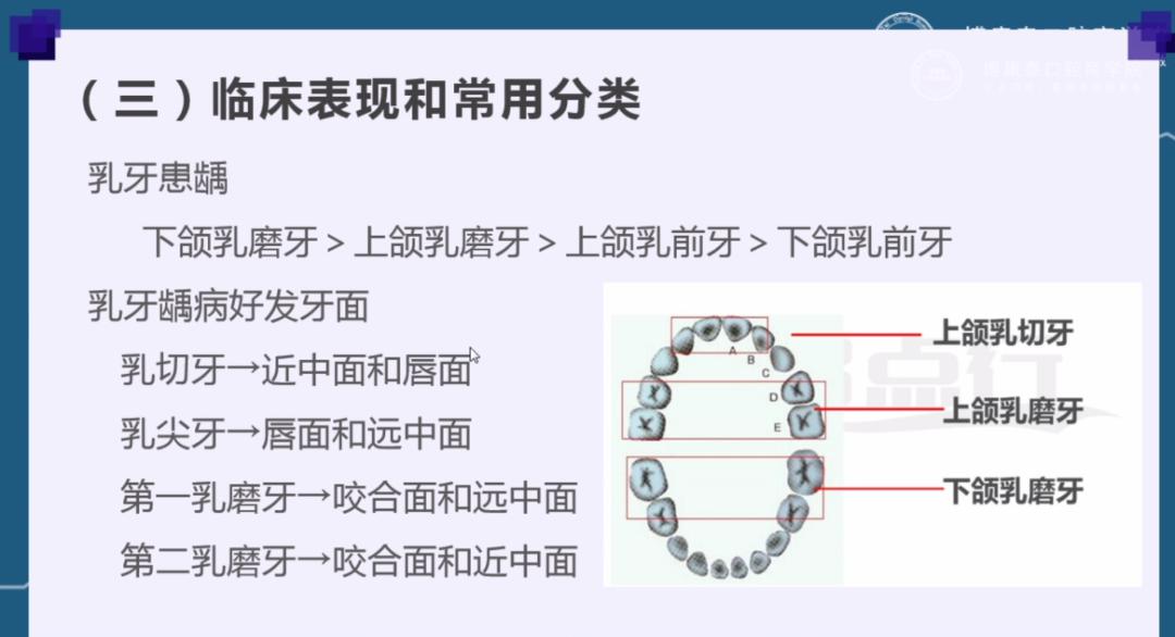 引起其下方正在发育的继承恒牙,造成个别牙的釉质发育不全,称为特纳牙
