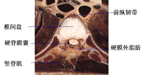 椎内静脉丛:位于硬膜外间隙内,在ct平扫上不能单独显示,增强扫描呈