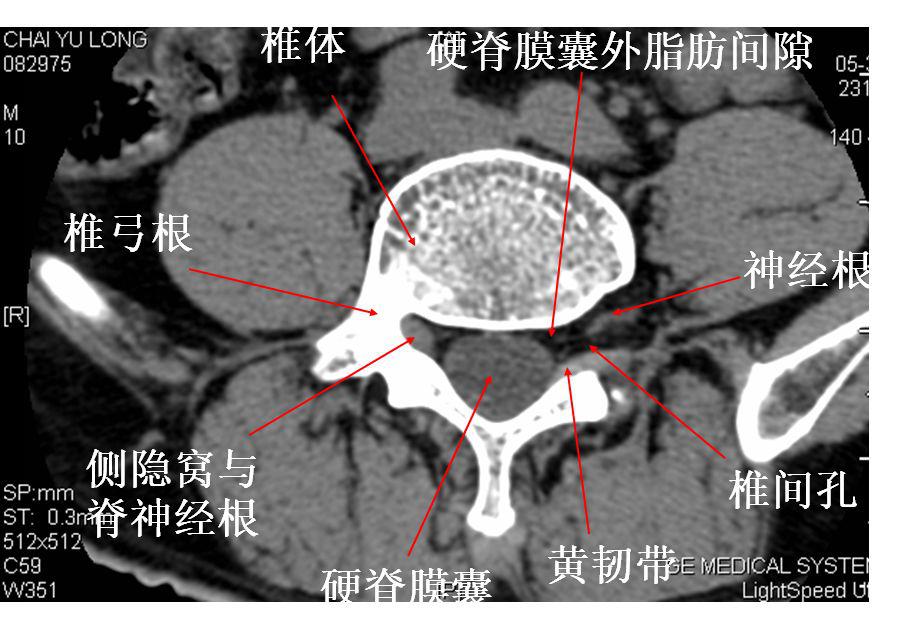 闭孔内肌CT图片