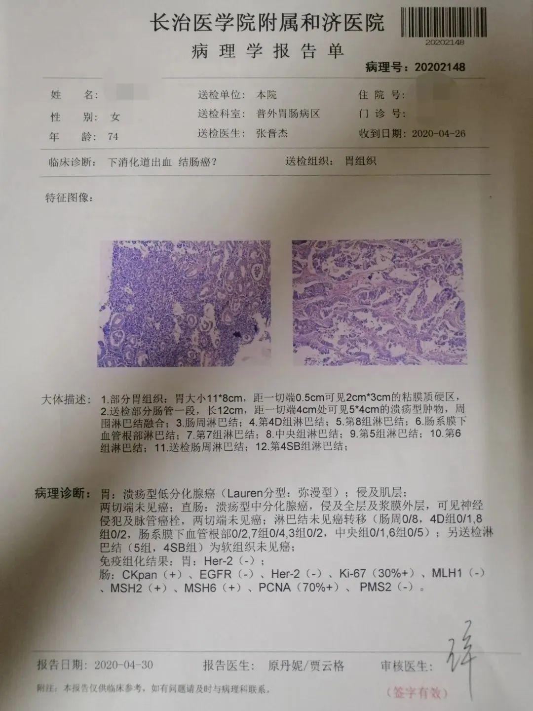 今年74岁,入院诊断为同时性胃癌 直肠癌,胃窦部肿瘤约3×2cm大小,侵及