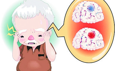 脑供血不足,捅向老年人的利刃 _大脑