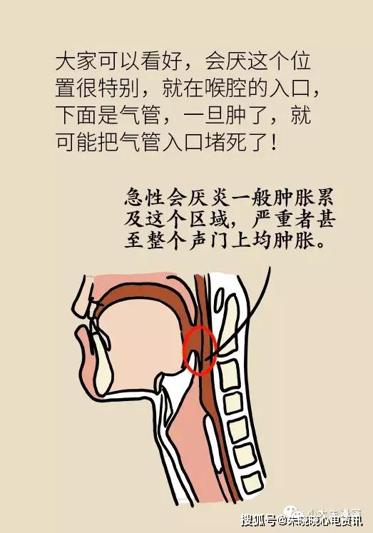 30岁女性嗓子疼险些丧命医生忠告嗓子疼伴随这五种症状赶紧去急诊