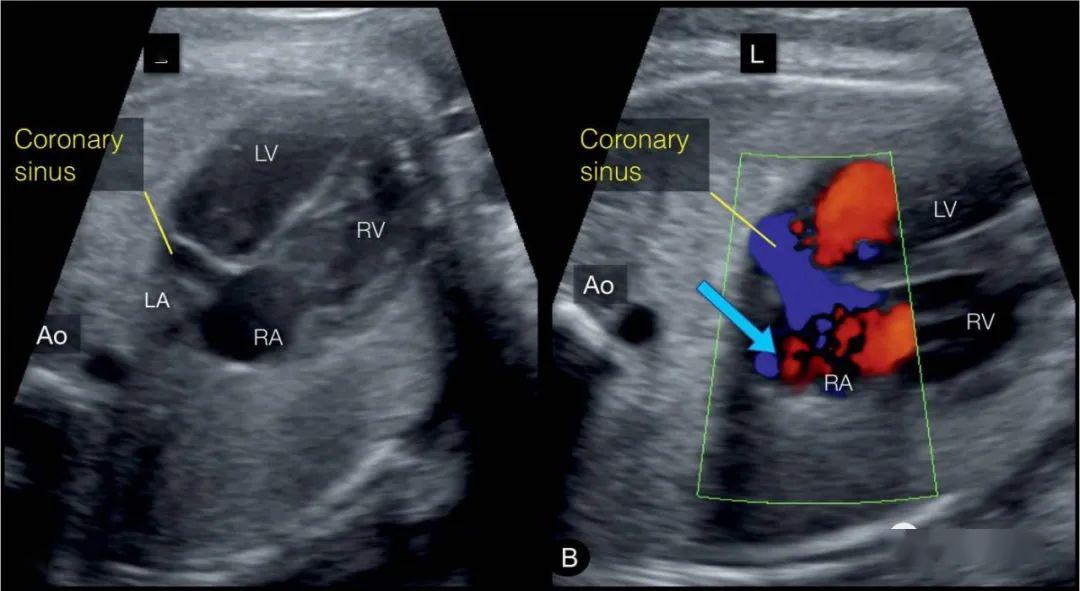胎儿静脉导管超声图片图片