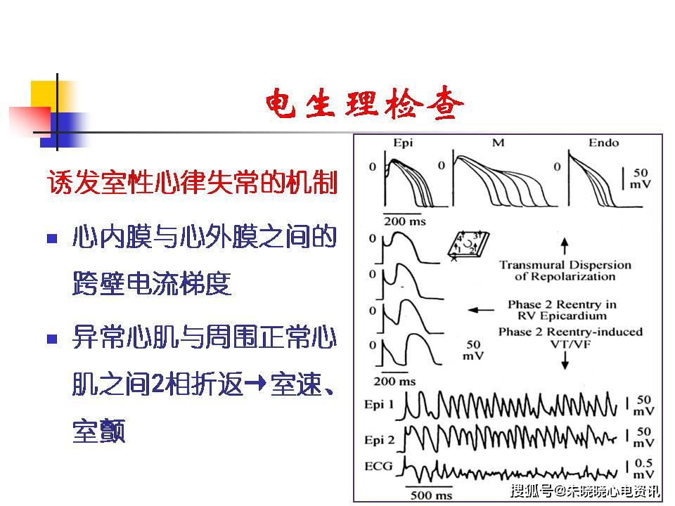 brugada综合症图片