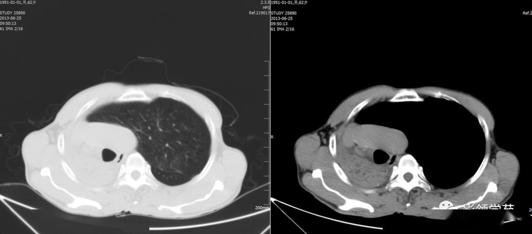 肺不张影像表现
