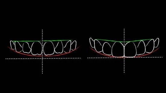 牙齿明明很整齐,为什么笑起来不好看?_中线