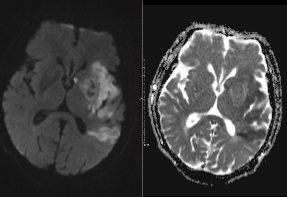 彌散加權mri 證實左側顳葉,島葉,基底節區大面積腦梗死.