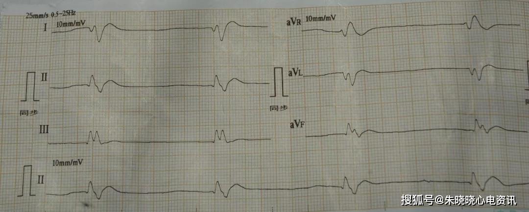 临终三种心电图及结论图片