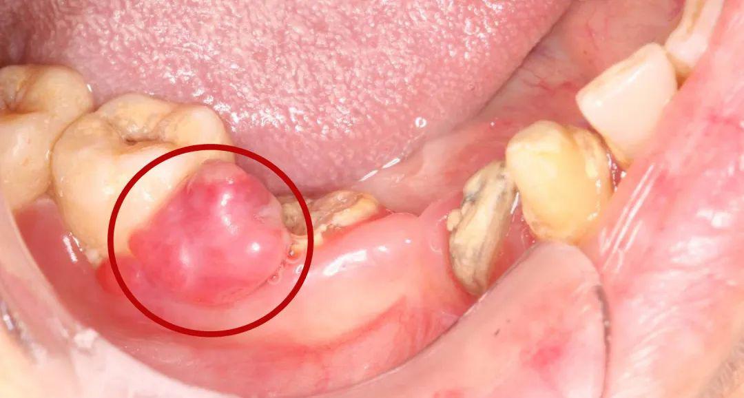 牙龈癌图片 症状早期图片