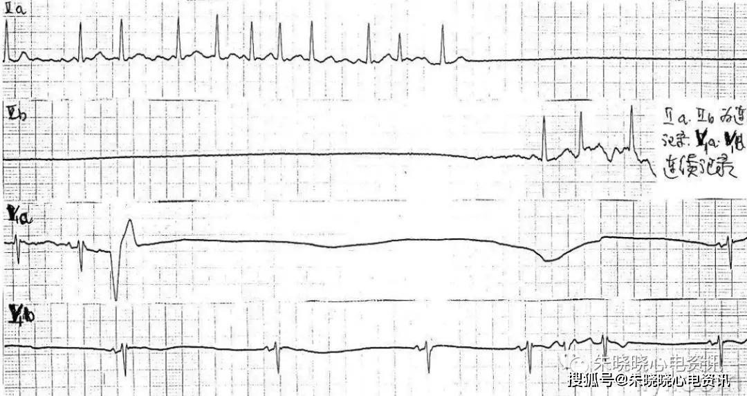 临终三种心电图及结论图片