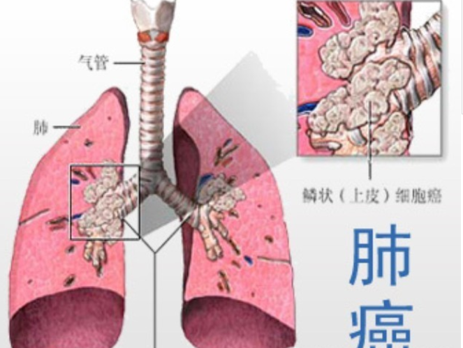 肺癌早期症状能活多久图片