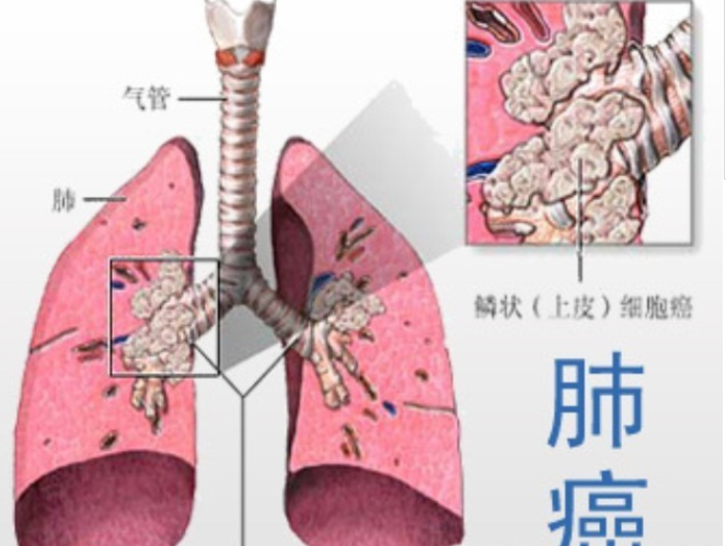 患上肺癌你到底還能活多久呢