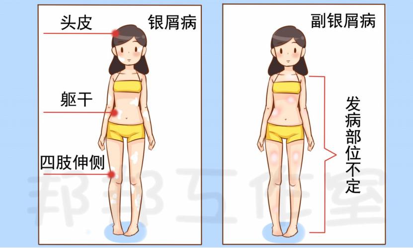 的发病部位没有银屑病有特征性,如银屑病常发生在头皮,躯干及四肢伸侧