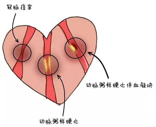 高血压或主动脉狭窄