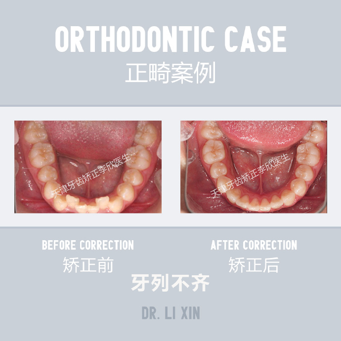 天津牙齿矫正李欣医生:【牙齿不齐正畸分享】