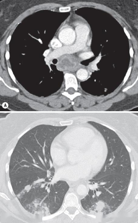 格艾选读丨纵隔疾病相关知识点2