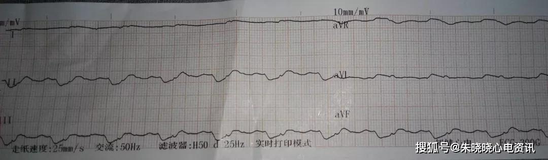 临终三种心电图及结论图片