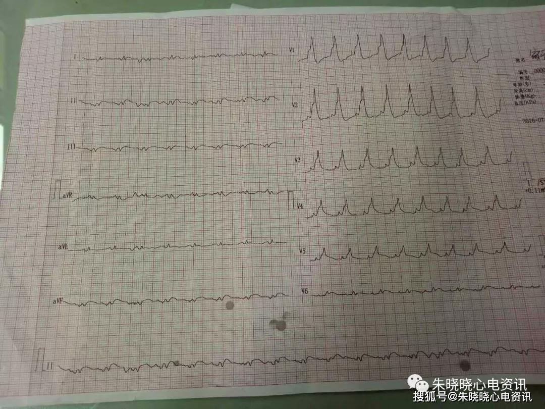 临终心电图诊断结论图片